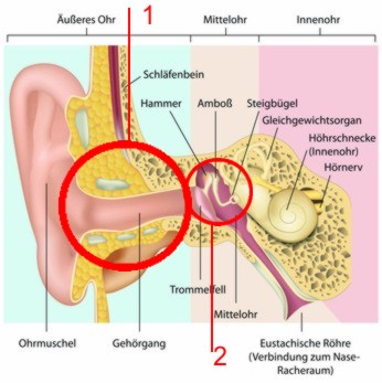 Schallleitungs-Schwerhörigkeit