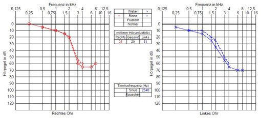 Audiogramm Hochton-Schwerhörigkeit