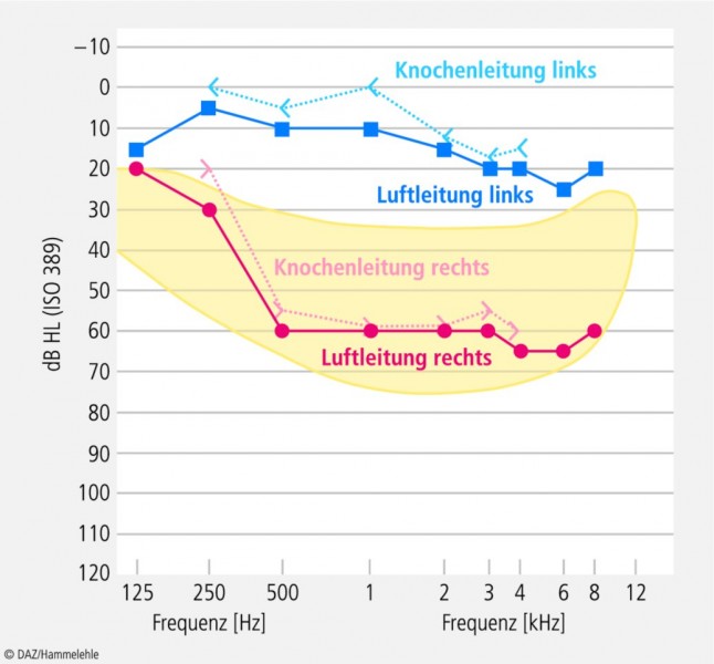 Tonaudigramm nach einem Hörsturz